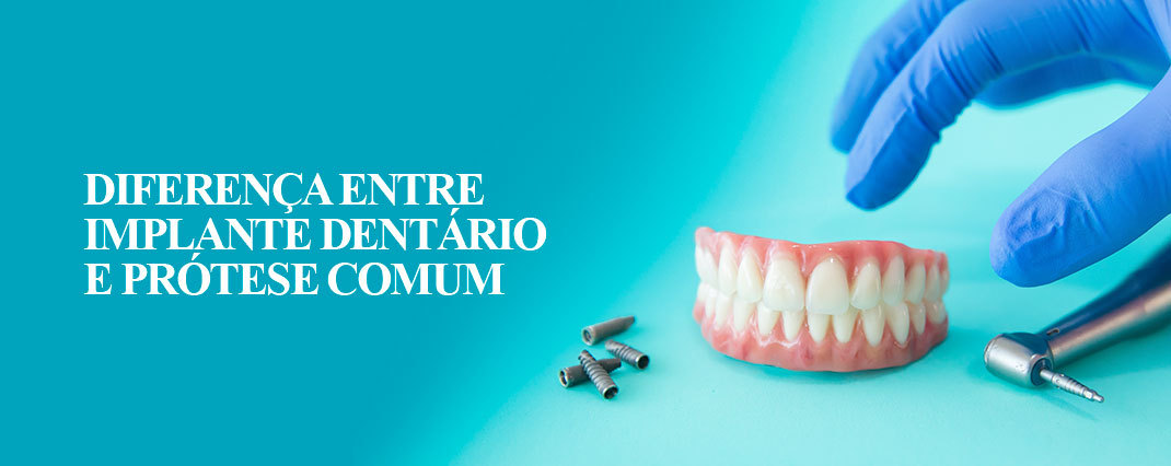 Diferença entre implante dentário e prótese comum