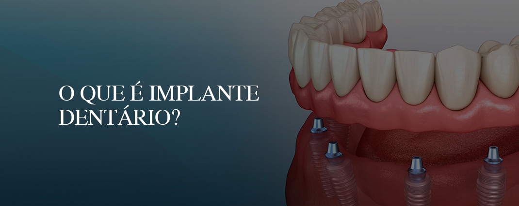 O que é Implante Dentário