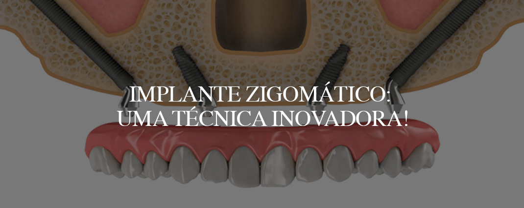 Implante Zigomático: uma técnica inovadora!